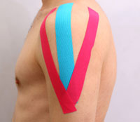 Kinesio Taping